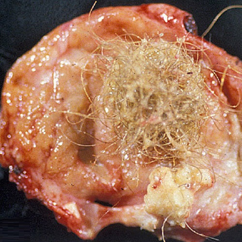 dermoid cyst pictures