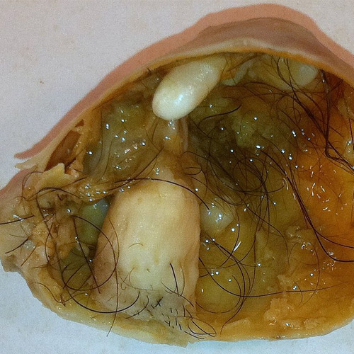 Minor operation to remove an infected sebaceous cyst