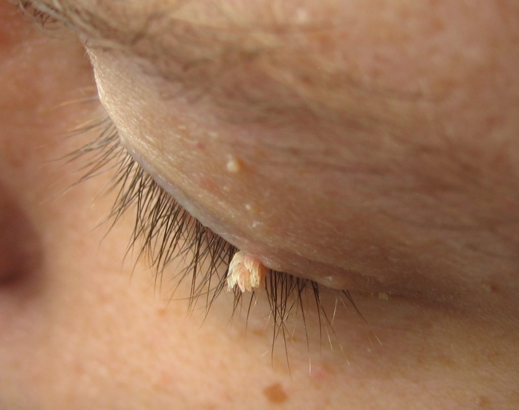 What Is An Eye Cyst Types Of Conjunctival Cystic Diseases