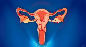types of ovarian cysts - endometriosis