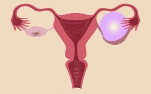 A womb and ovarian cyst complications