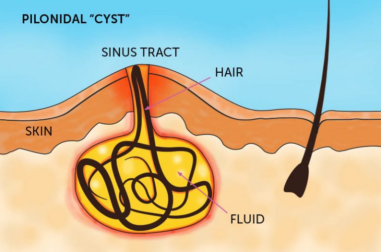 Pilonidal Cyst Causes Only One Thing Determines Course Of