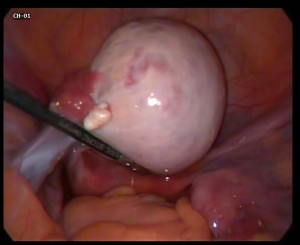 dermoid-cyst-of-the-ovary-2
