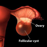 icd 10 code for follicular cyst right ovary