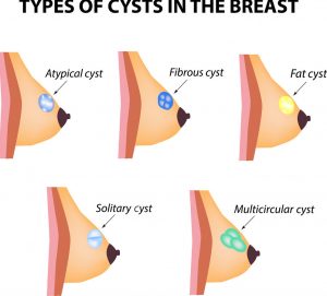 Breast benign tumor types - 6 most common dangers