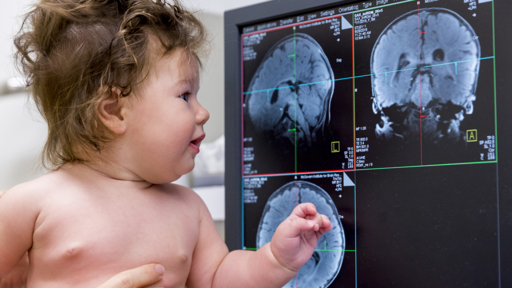 Cyst On Baby Brain What You Should Do Dangerous Complications