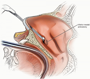 Caldwell-Luc for nasal cyst treatment