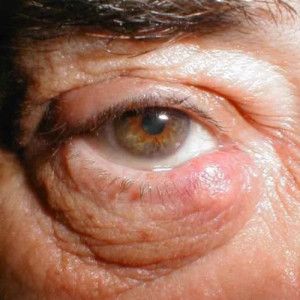 Chalazion eyelid (meibomian) cyst - everything to know