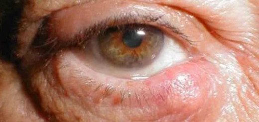 Chalazion eyelid (meibomian) cyst - everything to know