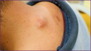 Types of skin cyst - which are dangerous? When you need doctor?