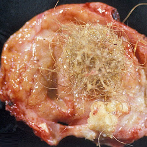 Dermoid cyst - everything to know. What's its main danger?