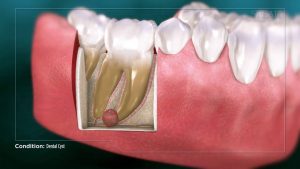 do not ignore dental cyst symptoms to make timely diagnosis