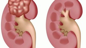 complex kidney cyst causes