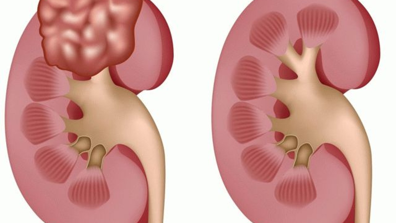 complex-kidney-cyst-causes-and-menacing-complications