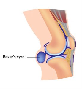 Baker's cyst behind the knee: causes, symptoms, diagnosis and treatment