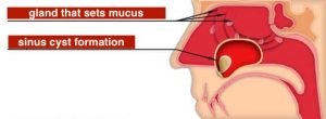 sinus cyst location