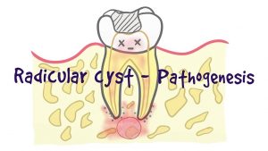 radicular dental cyst - dental cyst types