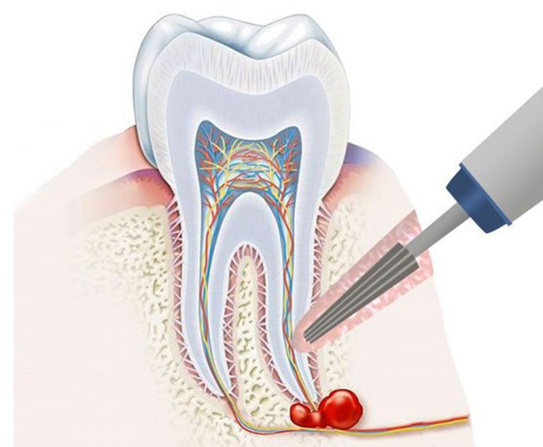 Methods Of Dental Cyst Treatment Surgery Laser Total Tooth Removal