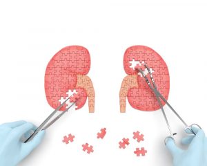 simple kidney cyst - renal cyst treatment