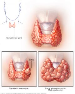 Thyroid nodules - general information everybody must know