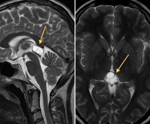 pineal cyst diagnosis