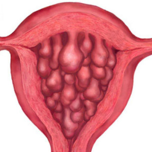 Endocervical cysts. Description - All information about cysts