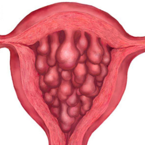 Endocervical cysts. Description