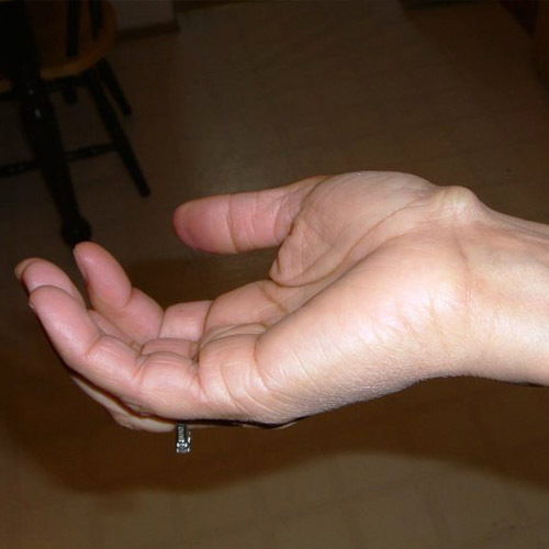 Hygroma of hand: causes, treatment and removal