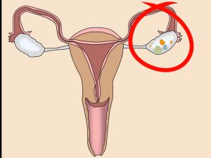 types of ovarian cysts during pregnancy