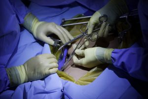 laparotomy helps get rid of ovarian cyst rupture