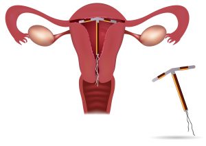 can intrauterine device cause ovarian cyst or cancer?