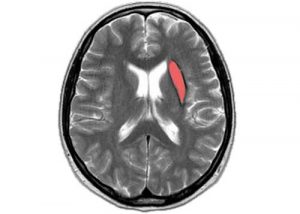 retrocerebellar brain cyst differences and characteristics