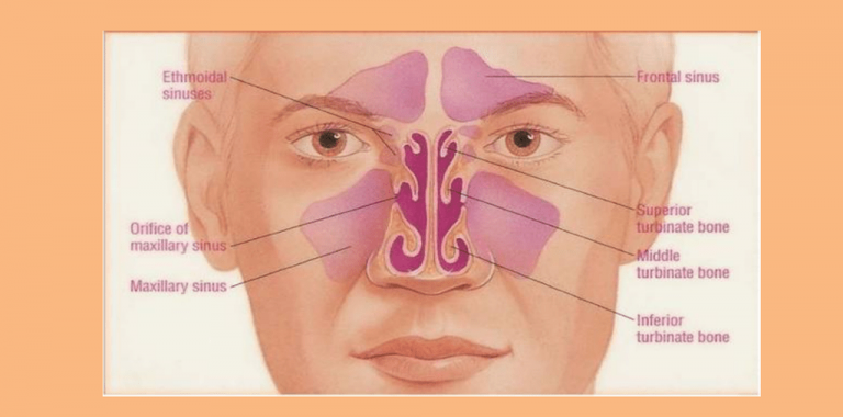 Maxillary sinus retention cysts symptomatic and causes