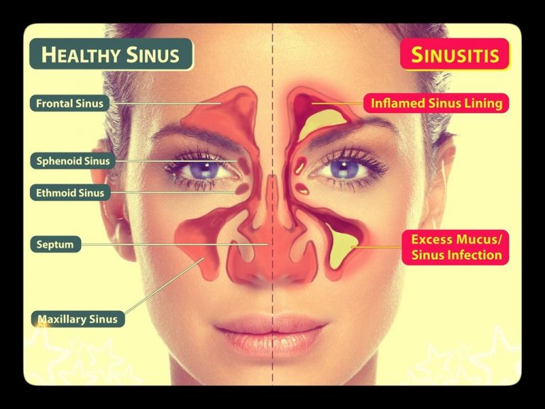 Is It True That Sinus Cyst Can Be Cancerous