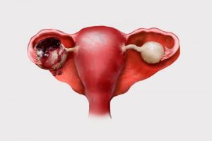 Endometrioid cyst structure