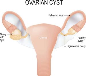 pain in the right groin is associated with ovarian cyst
