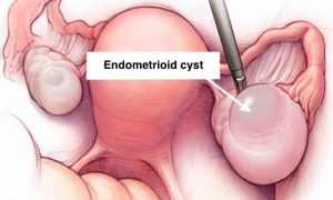 Endometrioid cyst causes pain in the right groin