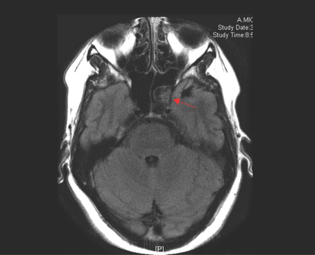 what-are-the-sphenoid-sinus-cyst-symptoms-how-dangerous-is-it-all