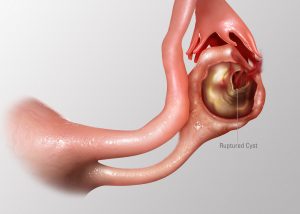 raptured ovarian cyst is among ovarian cyst complications