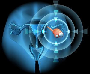 ovarian cyst can cause groin pain