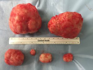 uterus fibroids sizes