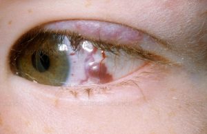 Hemangioma of the eye cyst