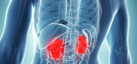 parapelvic simple kidney cyst