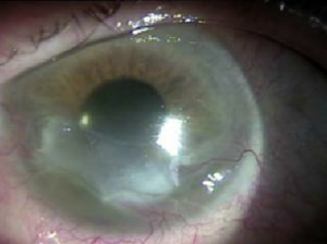 eye cyst
