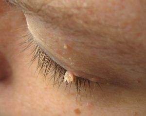 papilloma eye cyst symptoms 