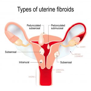uterus fibroids types