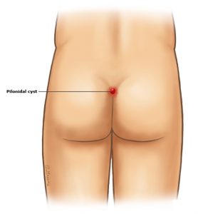 Location of a pilonidal cyst - Pilonidal cyst recovery time - things to know after surgery