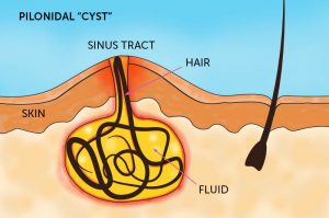 Structure of a pilonidal cyst - Pilonidal cyst recovery time - things to know after surgery