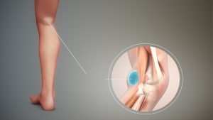 Baker's cyst causes - things to avoid. Can we prevent it for sure?