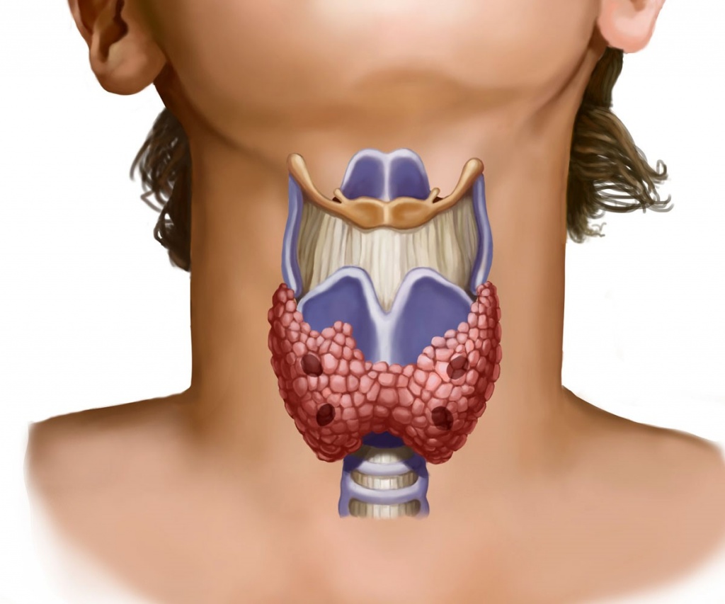 Can Stress Cause Thyroid Nodules